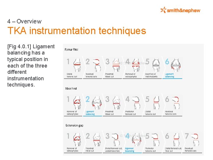 4 – Overview TKA instrumentation techniques [Fig 4. 0. 1] Ligament balancing has a