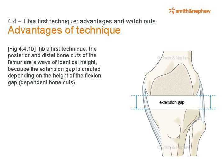 4. 4 – Tibia first technique: advantages and watch outs Advantages of technique [Fig