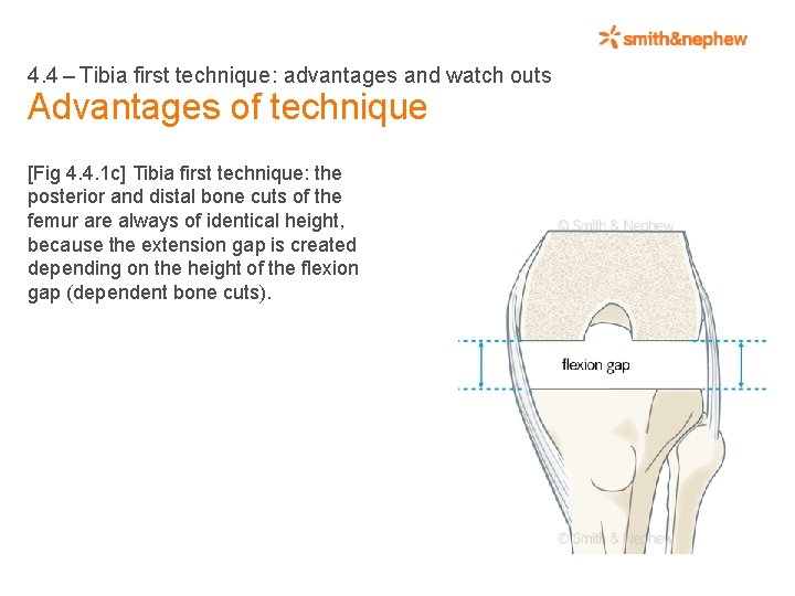 4. 4 – Tibia first technique: advantages and watch outs Advantages of technique [Fig