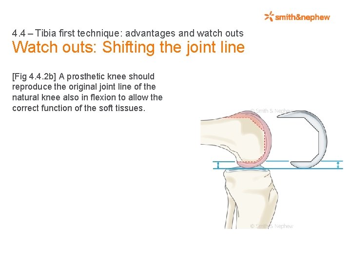 4. 4 – Tibia first technique: advantages and watch outs Watch outs: Shifting the