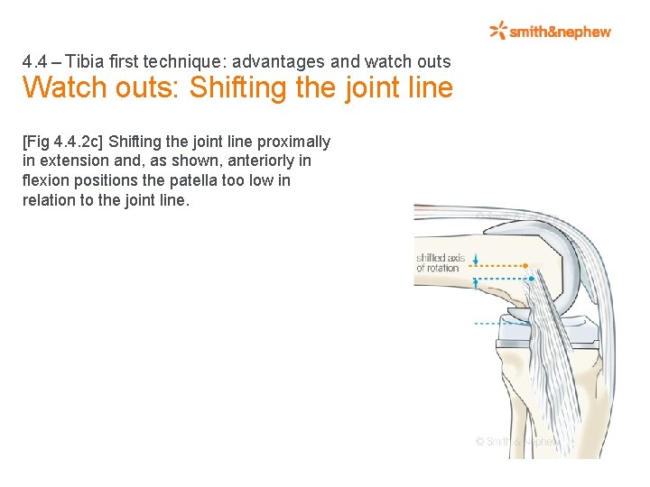 4. 4 – Tibia first technique: advantages and watch outs Watch outs: Shifting the