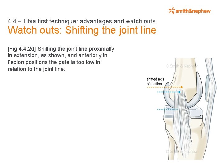 4. 4 – Tibia first technique: advantages and watch outs Watch outs: Shifting the