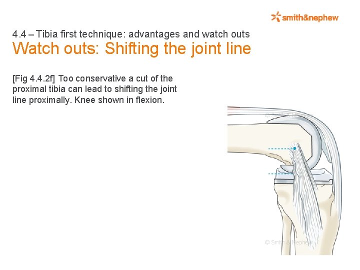 4. 4 – Tibia first technique: advantages and watch outs Watch outs: Shifting the