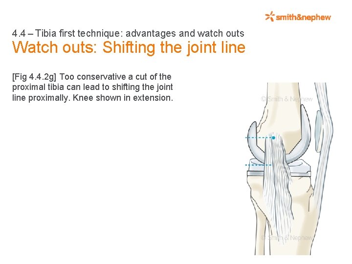 4. 4 – Tibia first technique: advantages and watch outs Watch outs: Shifting the