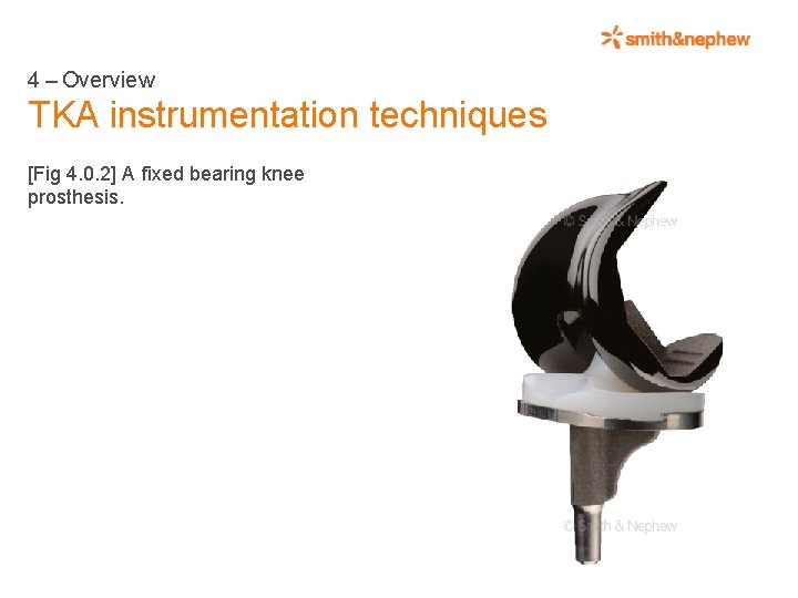 4 – Overview TKA instrumentation techniques [Fig 4. 0. 2] A fixed bearing knee