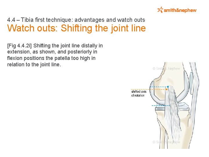 4. 4 – Tibia first technique: advantages and watch outs Watch outs: Shifting the