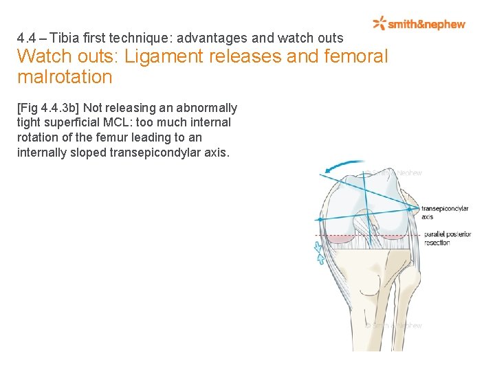 4. 4 – Tibia first technique: advantages and watch outs Watch outs: Ligament releases