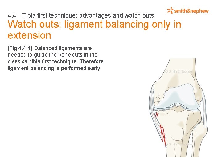 4. 4 – Tibia first technique: advantages and watch outs Watch outs: ligament balancing