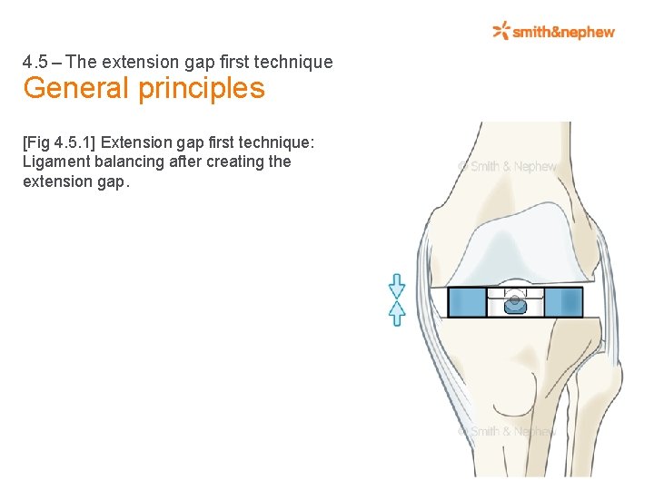 4. 5 – The extension gap first technique General principles [Fig 4. 5. 1]