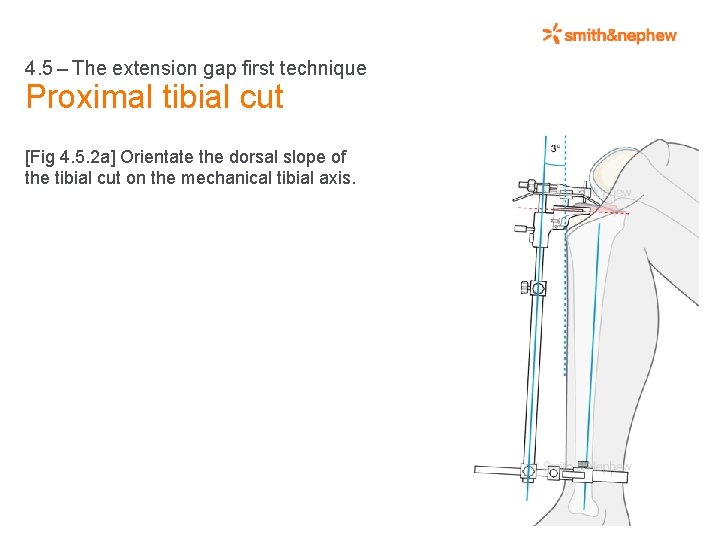 4. 5 – The extension gap first technique Proximal tibial cut [Fig 4. 5.