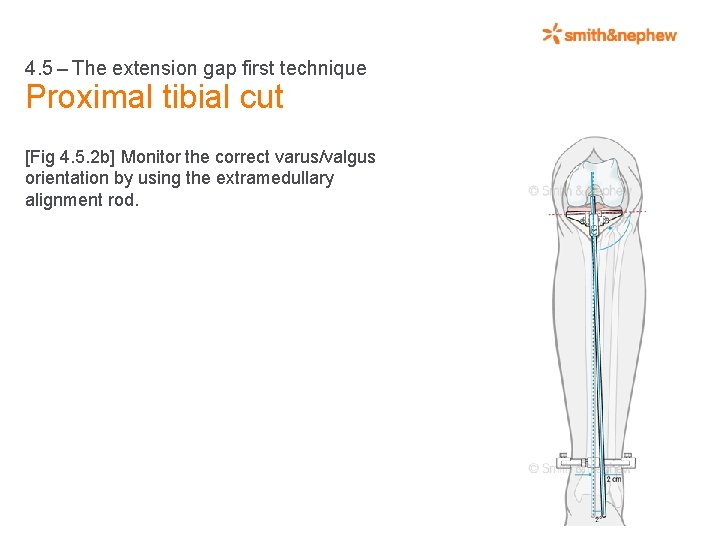 4. 5 – The extension gap first technique Proximal tibial cut [Fig 4. 5.