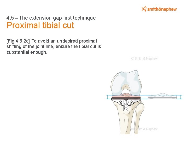 4. 5 – The extension gap first technique Proximal tibial cut [Fig 4. 5.