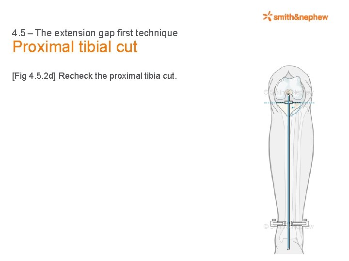 4. 5 – The extension gap first technique Proximal tibial cut [Fig 4. 5.