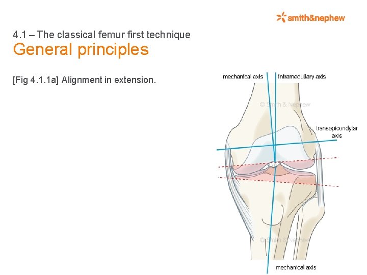 4. 1 – The classical femur first technique General principles [Fig 4. 1. 1
