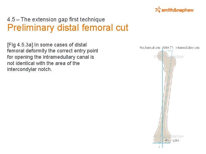 4. 5 – The extension gap first technique Preliminary distal femoral cut [Fig 4.