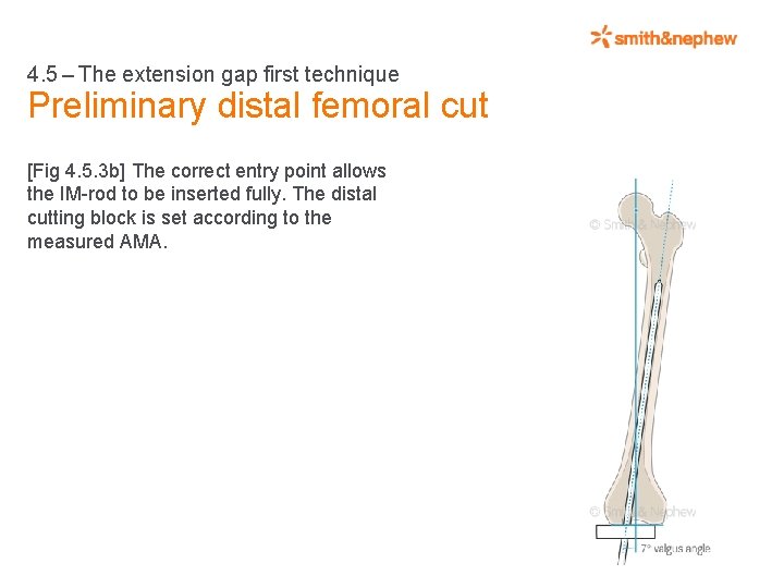 4. 5 – The extension gap first technique Preliminary distal femoral cut [Fig 4.
