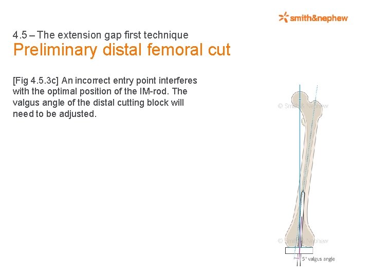 4. 5 – The extension gap first technique Preliminary distal femoral cut [Fig 4.