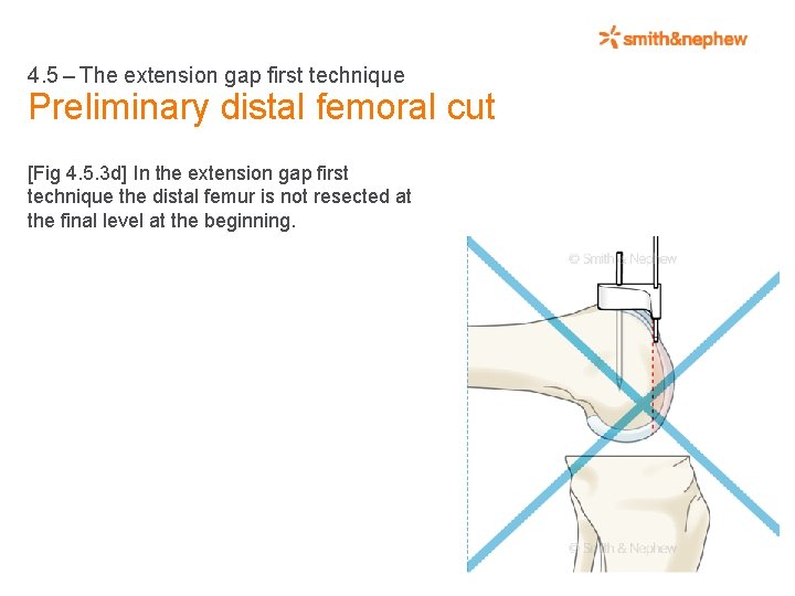 4. 5 – The extension gap first technique Preliminary distal femoral cut [Fig 4.