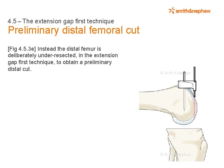 4. 5 – The extension gap first technique Preliminary distal femoral cut [Fig 4.