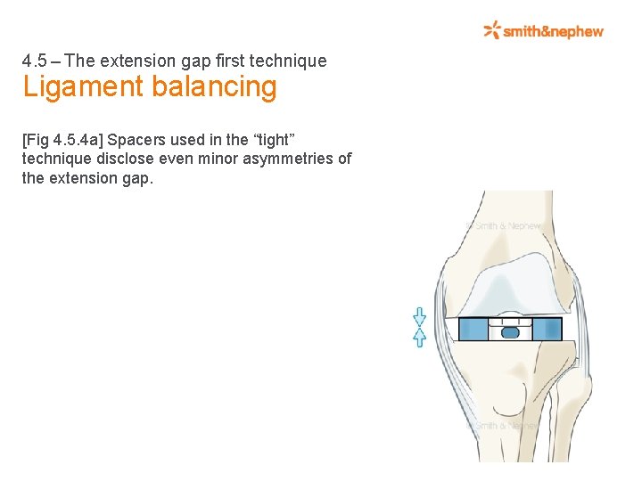 4. 5 – The extension gap first technique Ligament balancing [Fig 4. 5. 4