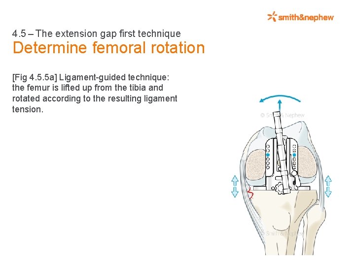 4. 5 – The extension gap first technique Determine femoral rotation [Fig 4. 5.