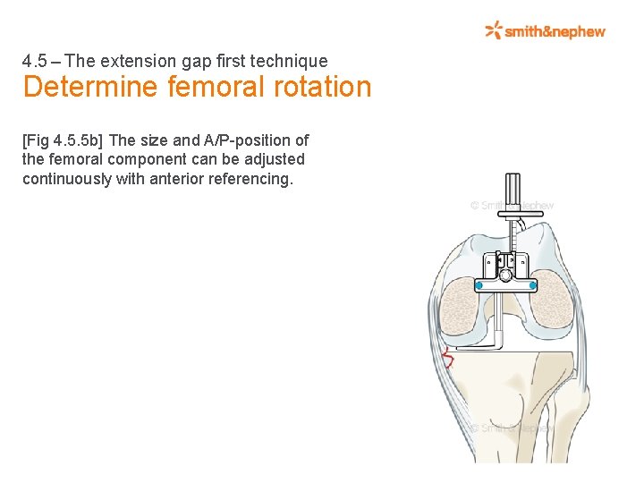 4. 5 – The extension gap first technique Determine femoral rotation [Fig 4. 5.