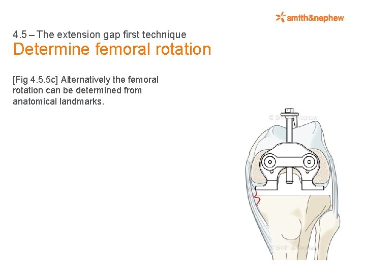4. 5 – The extension gap first technique Determine femoral rotation [Fig 4. 5.