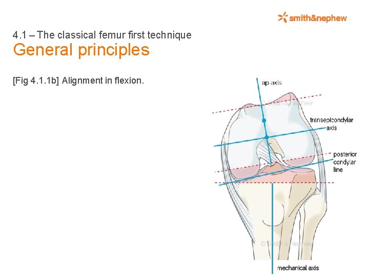 4. 1 – The classical femur first technique General principles [Fig 4. 1. 1