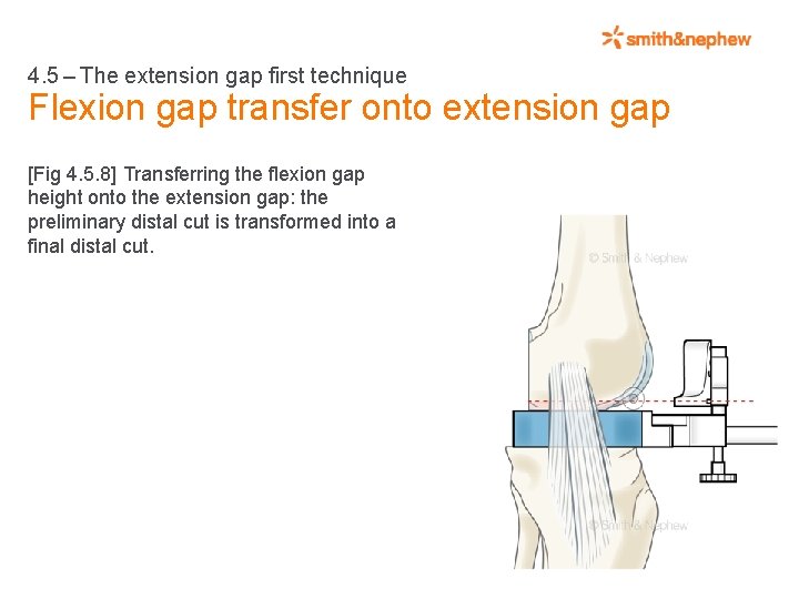 4. 5 – The extension gap first technique Flexion gap transfer onto extension gap