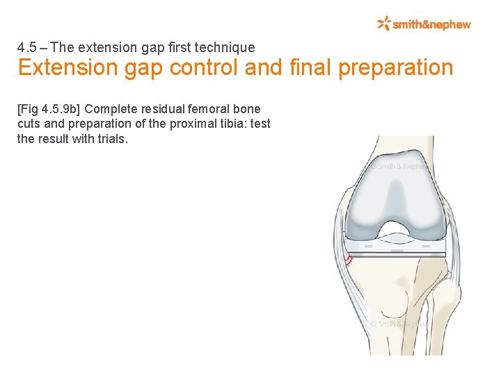 4. 5 – The extension gap first technique Extension gap control and final preparation