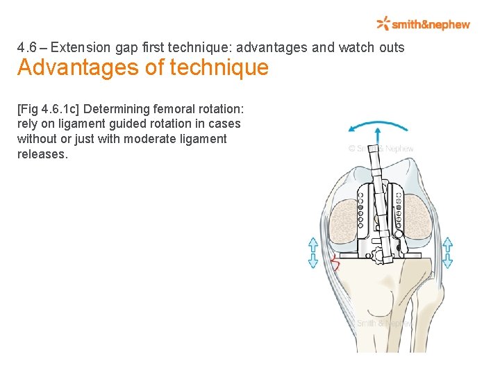 4. 6 – Extension gap first technique: advantages and watch outs Advantages of technique