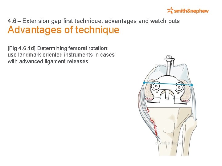 4. 6 – Extension gap first technique: advantages and watch outs Advantages of technique