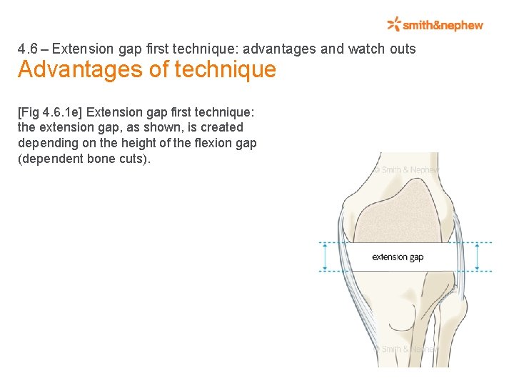 4. 6 – Extension gap first technique: advantages and watch outs Advantages of technique