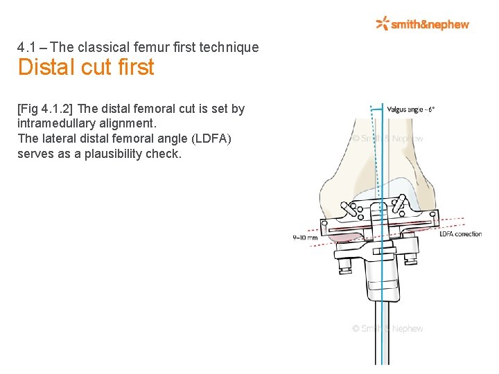 4. 1 – The classical femur first technique Distal cut first [Fig 4. 1.