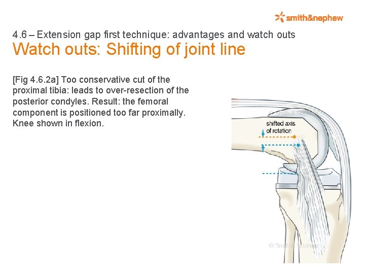 4. 6 – Extension gap first technique: advantages and watch outs Watch outs: Shifting