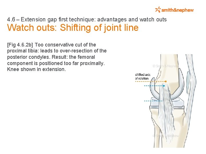 4. 6 – Extension gap first technique: advantages and watch outs Watch outs: Shifting