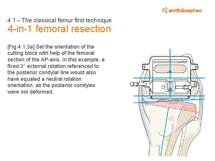 4. 1 – The classical femur first technique 4 -in-1 femoral resection [Fig 4.