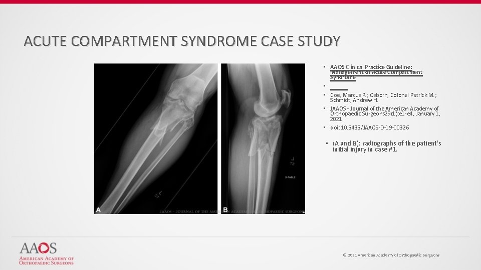 ACUTE COMPARTMENT SYNDROME CASE STUDY • AAOS Clinical Practice Guideline: Management of Acute Compartment