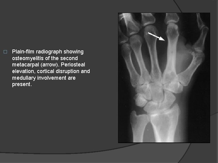 � Plain-film radiograph showing osteomyelitis of the second metacarpal (arrow). Periosteal elevation, cortical disruption