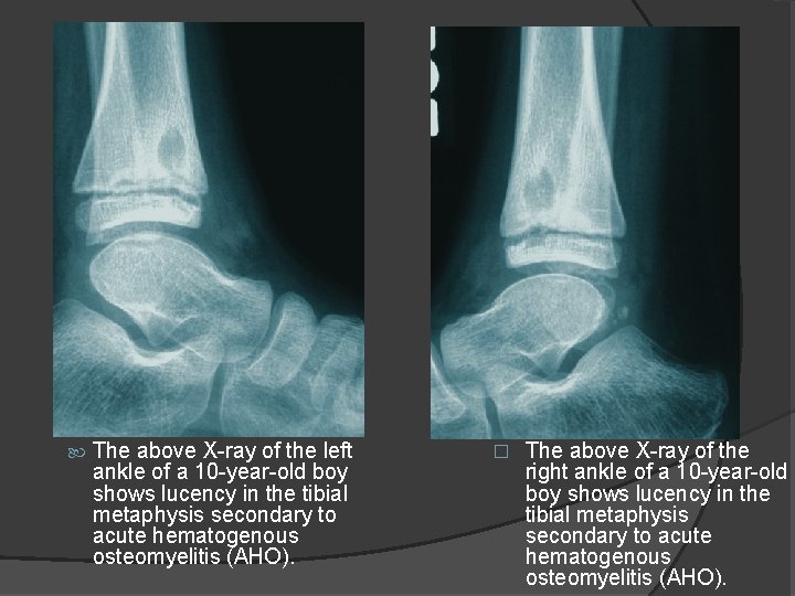  The above X-ray of the left ankle of a 10 -year-old boy shows