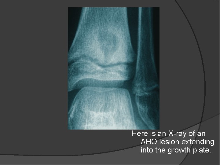 Here is an X-ray of an AHO lesion extending into the growth plate. 