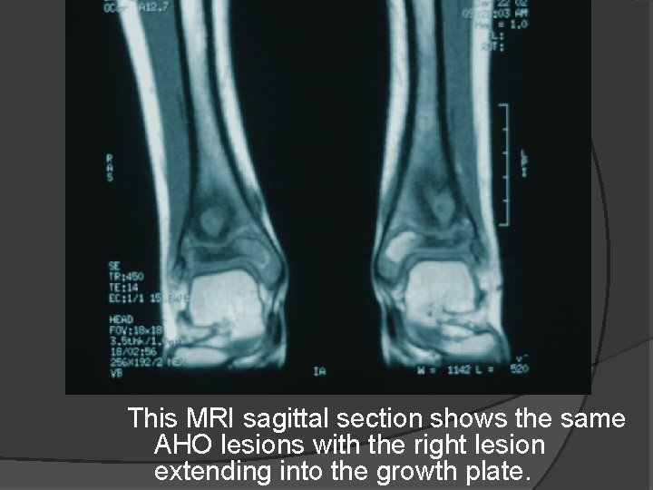 This MRI sagittal section shows the same AHO lesions with the right lesion extending