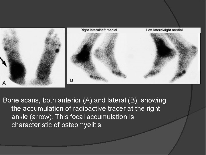 Bone scans, both anterior (A) and lateral (B), showing the accumulation of radioactive tracer