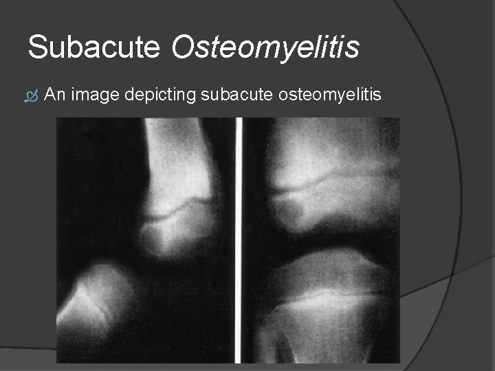 Subacute Osteomyelitis An image depicting subacute osteomyelitis 