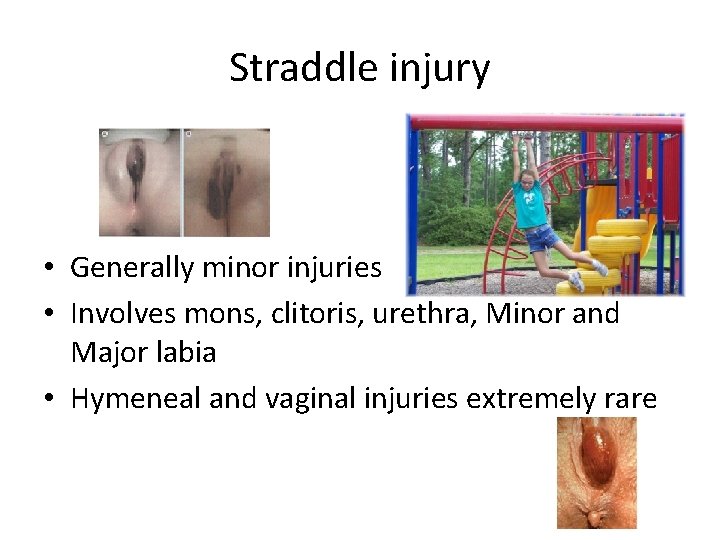 Straddle injury • Generally minor injuries • Involves mons, clitoris, urethra, Minor and Major