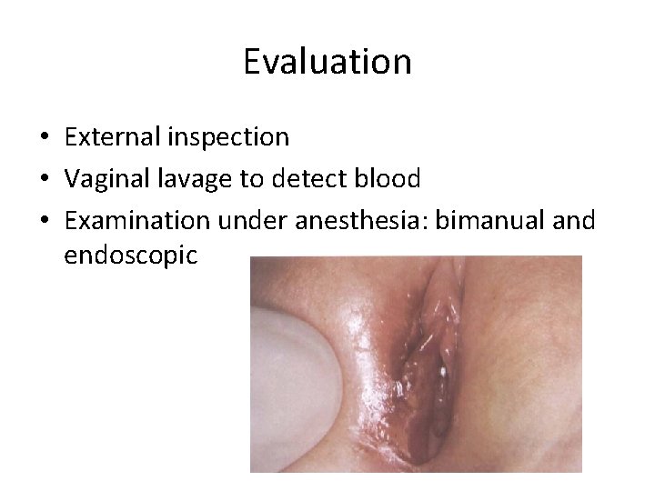 Evaluation • External inspection • Vaginal lavage to detect blood • Examination under anesthesia: