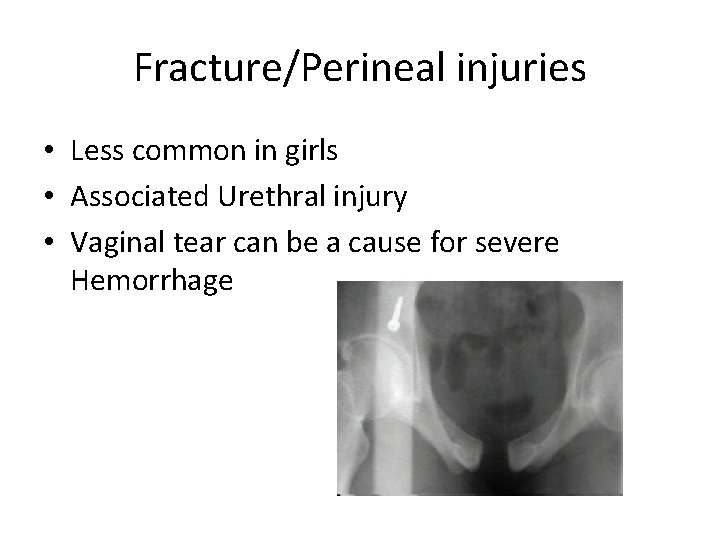 Fracture/Perineal injuries • Less common in girls • Associated Urethral injury • Vaginal tear