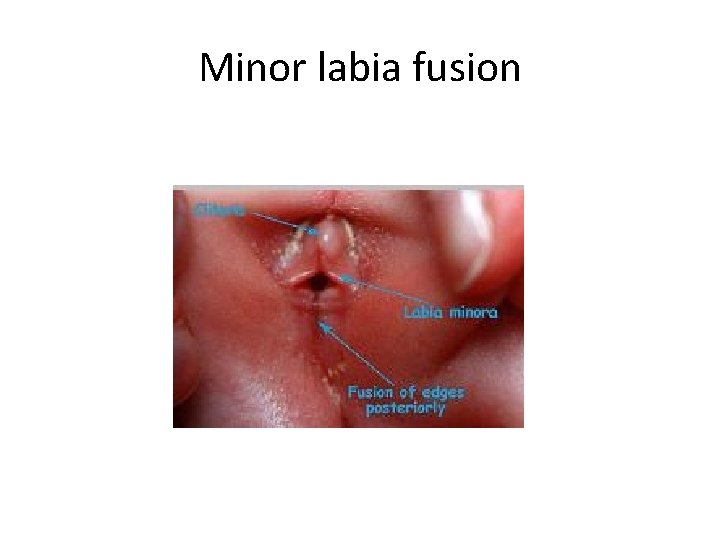 Minor labia fusion 