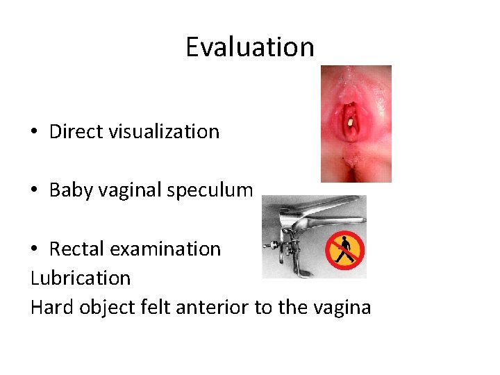 Evaluation • Direct visualization • Baby vaginal speculum • Rectal examination Lubrication Hard object