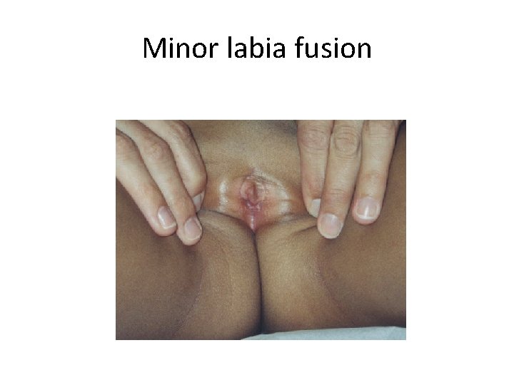 Minor labia fusion 